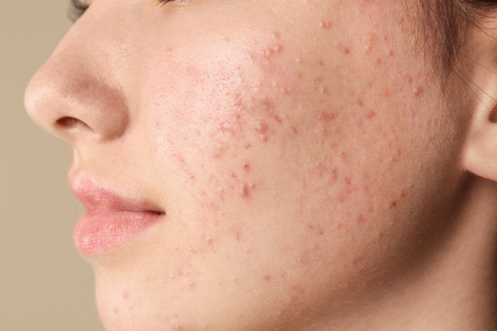PRP for scars