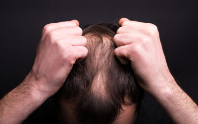 PRP for hairloss