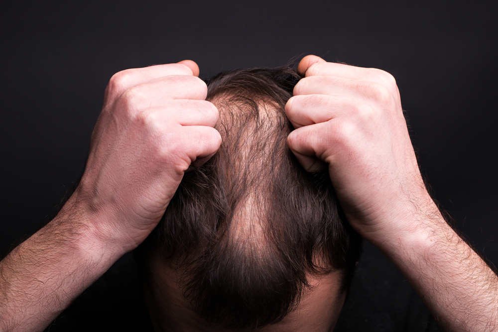 PRP for hairloss